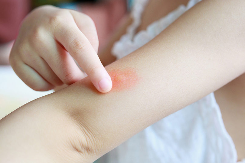 little-girl-has-skin-rash-and-allergy-from-mosquito-bite